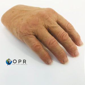 Prothèse de main pour doigts coupés. Esthétique en silicone pour agénésie partielle, amputation partielle orthopédie à Rennes et caen
