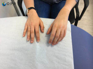 Prothèse de main esthétique en silicone pour doigts coupés. Agénésie partielle, amputation partielle orthopédie à Rennes et caen