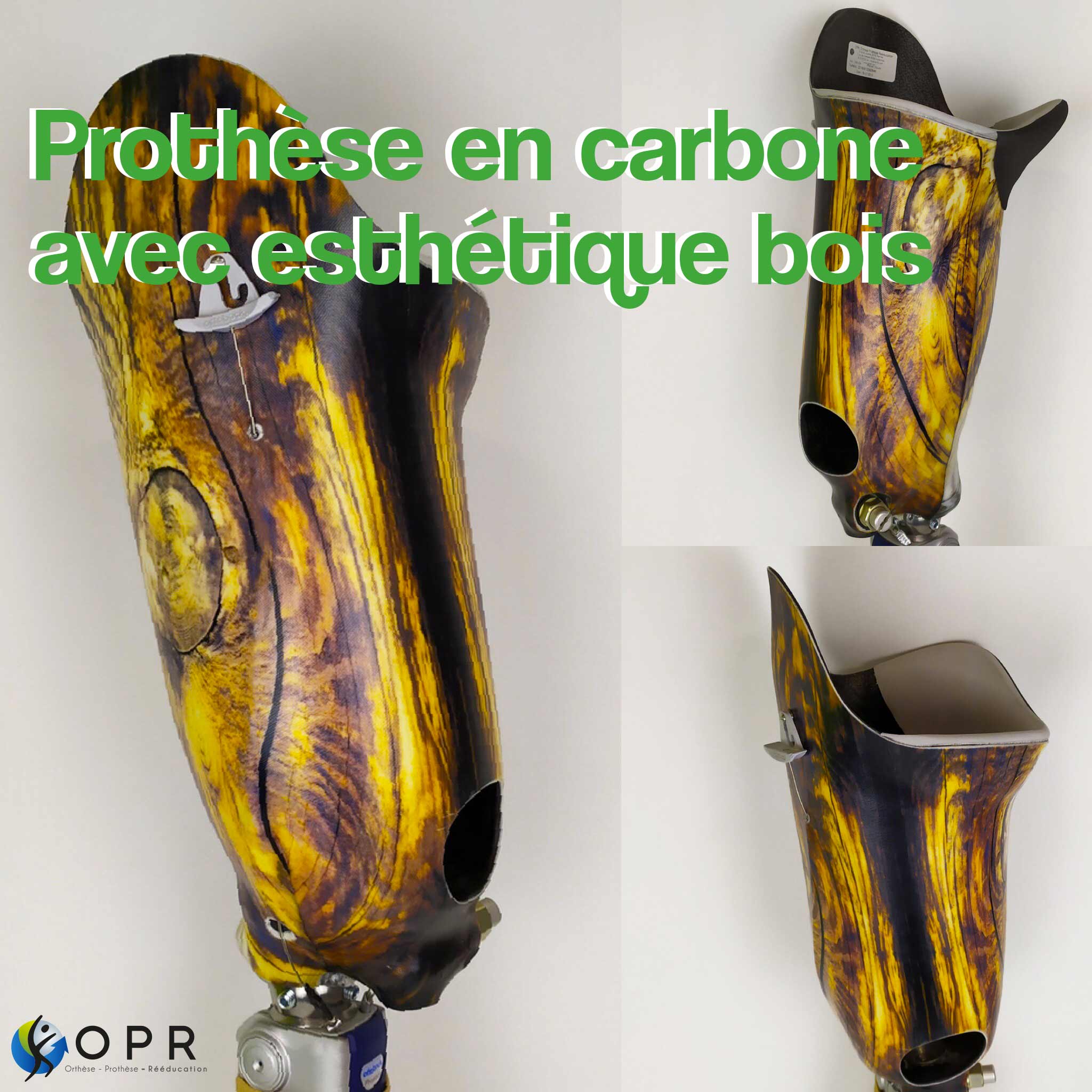 Prothèse fémorale carbone avec esthétique bois