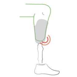 l'emboiture de la prothèse est trop petite et le mogon est serré dans la prothèse