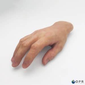 prothèse de main pour amputation partielle de la main ou des doigts, une prothèse esthétique réaliste en silicone en bretagne en ile et vilaine et dans la manche dans les établissements d'Arvanches et Saint Lo