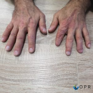 prothèse esthétique silicone haute définition pour amputation des doigts, en bretagne chez votre prothésiste de rennes ou en normandie a saint lo et a avranches