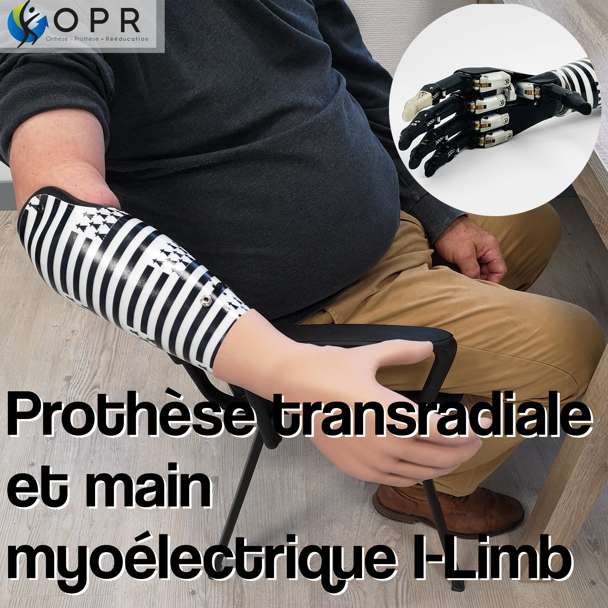 Prothèse transradiale avec motif Breton et main ILimb